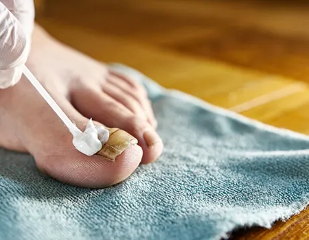 علت ایجاد قارچ ناخن دست و پا و درمان آن