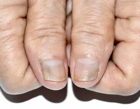 تغییر رنگ ناخن دست و پا: علل، علائم و راه های پیشگیری