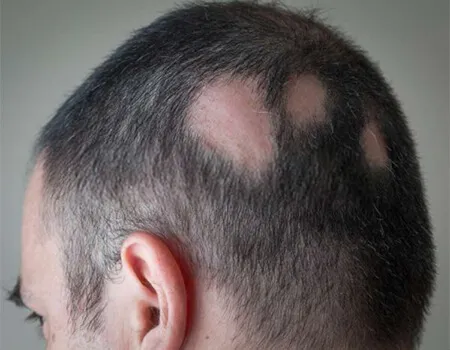 ریزش موی سکه‌ای را چگونه درمان کنیم؟