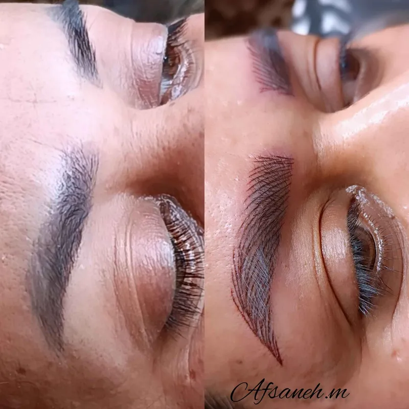 انجام میکرو روی تتو قدیمی