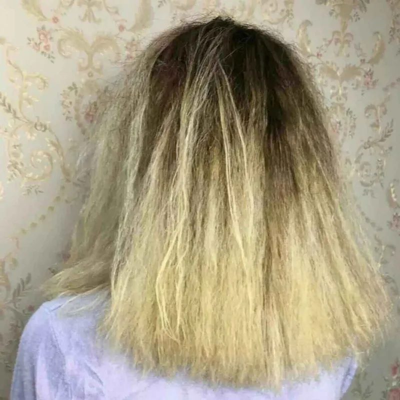 بوتاکس تراپی