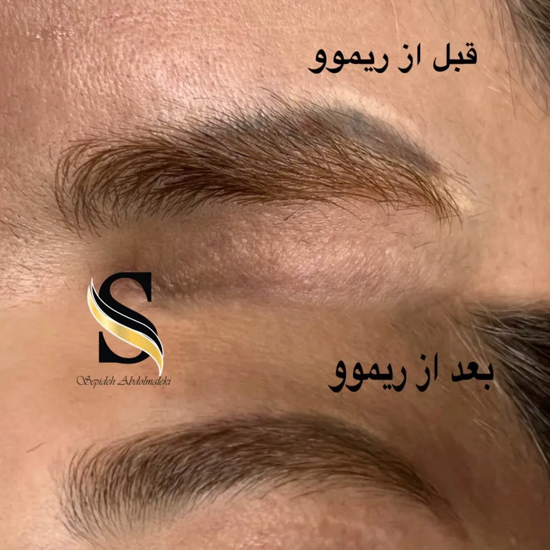 ریموو تک جلسه ایی