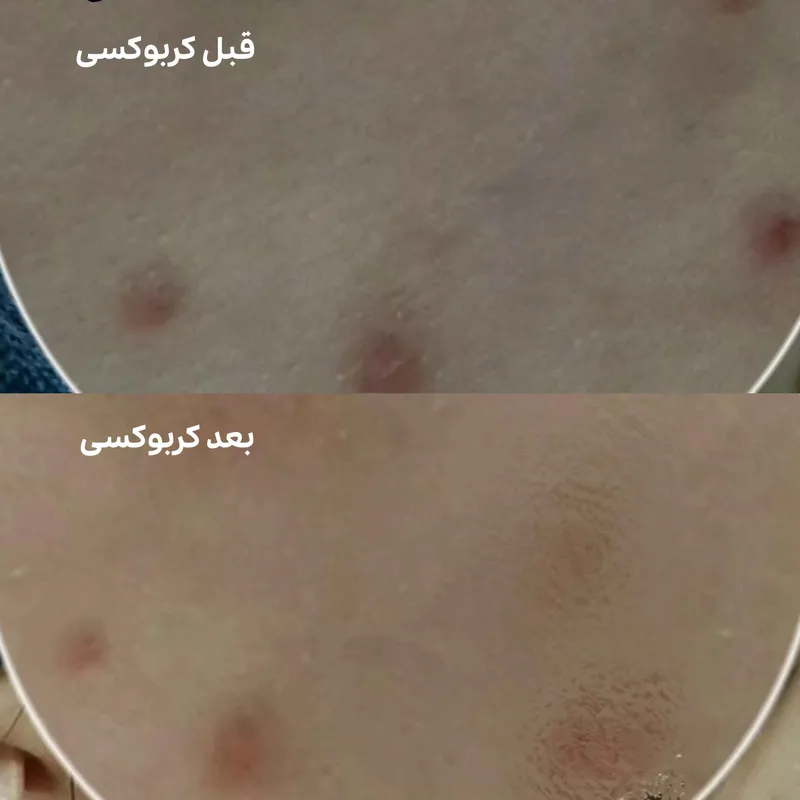 کربوکسی تراپی