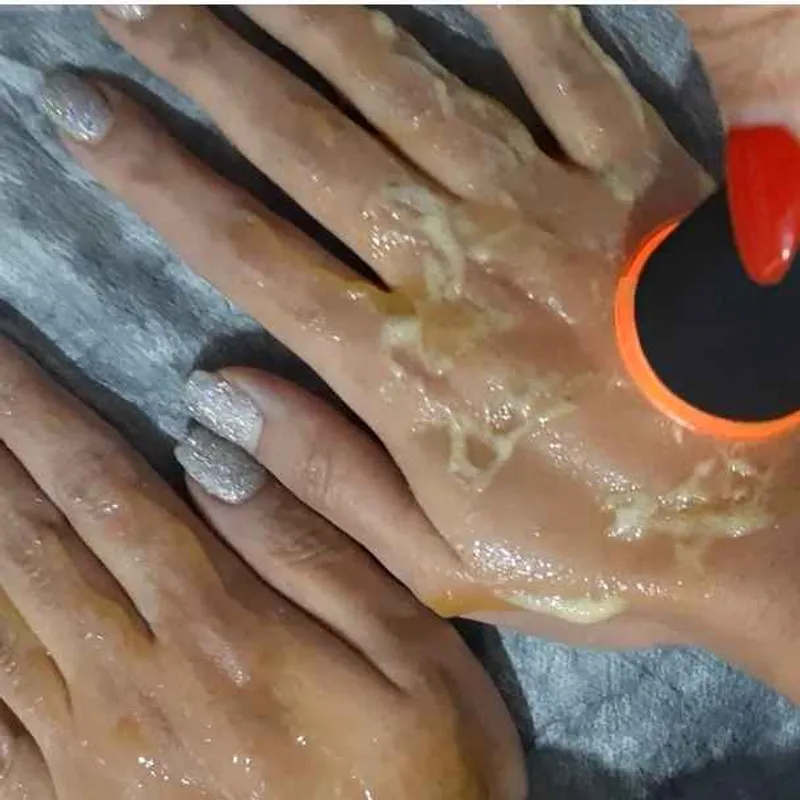 پلاژن تراپی دستها