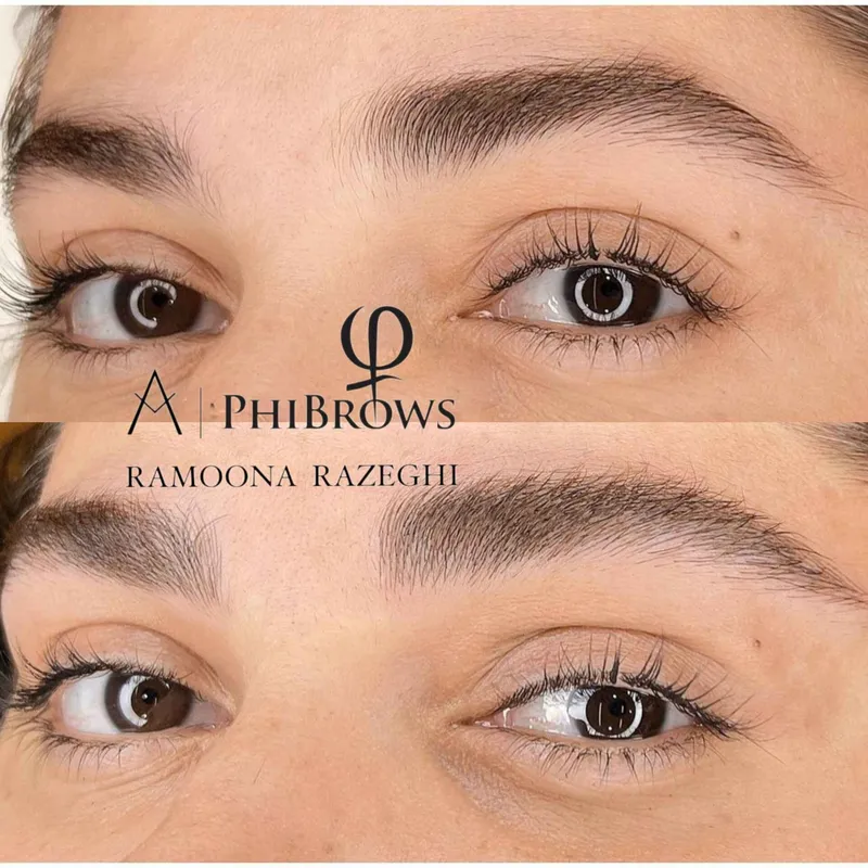 میکروبلیدینگ کرکی و مویی