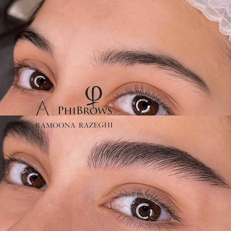 میکروبلیدینگ کرکی و مویی