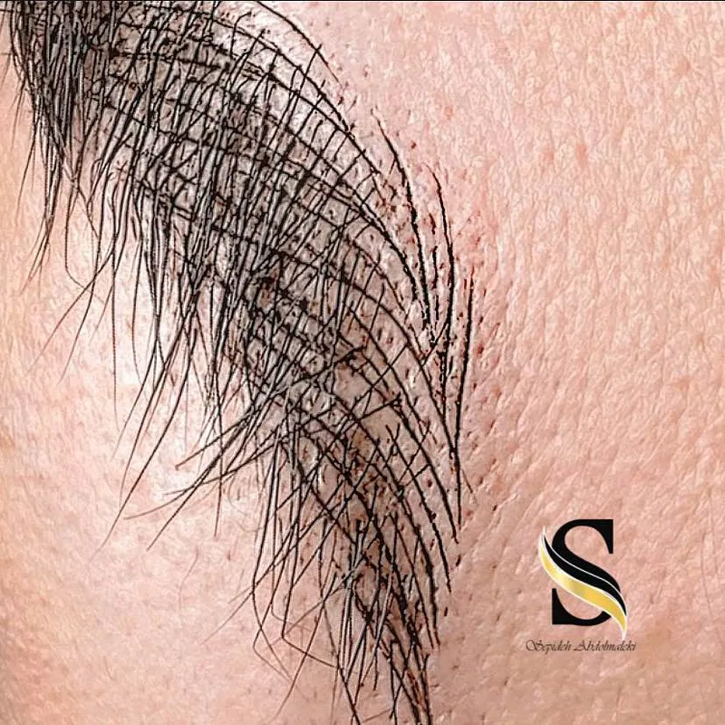 میکروبلیدینگ