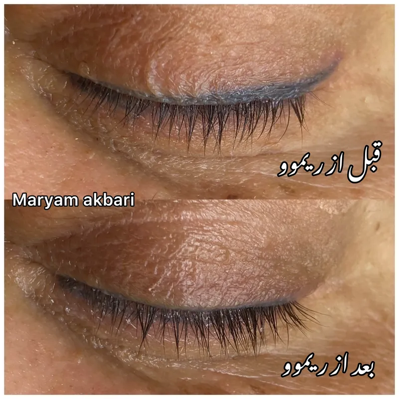 ریموو خط چشم