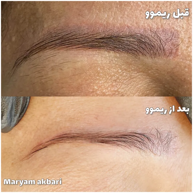 ریموو ابرو قرمز