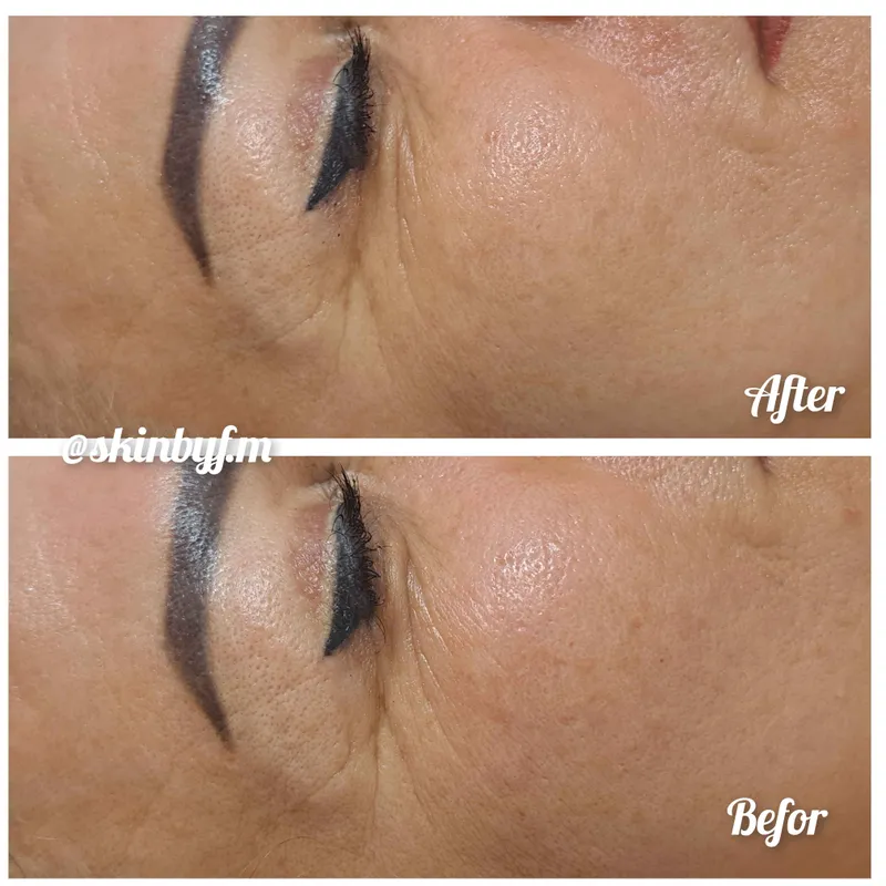 کربوکسی تراپی چروک