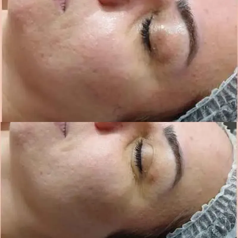 پاکسازی و جوانسازی پوست و درمان تیرگی دورچشم