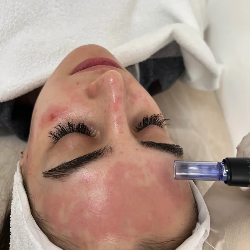 میکرونیدلینگ پوست و مو