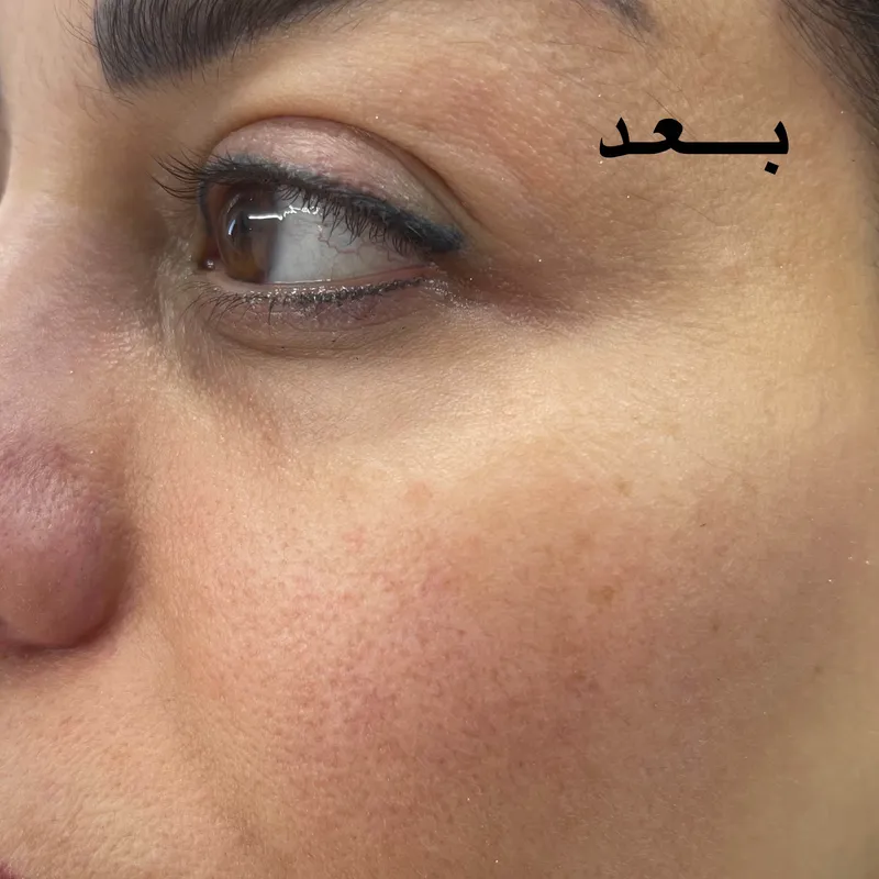 درمان تیرگی و چروک دور چشم