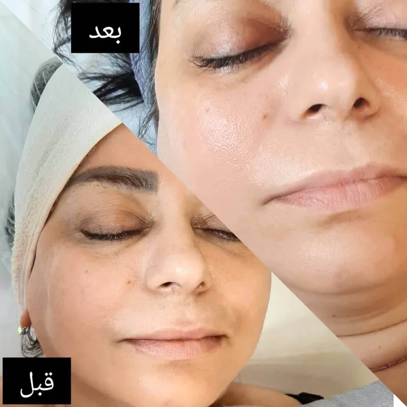 فیشیال صورت