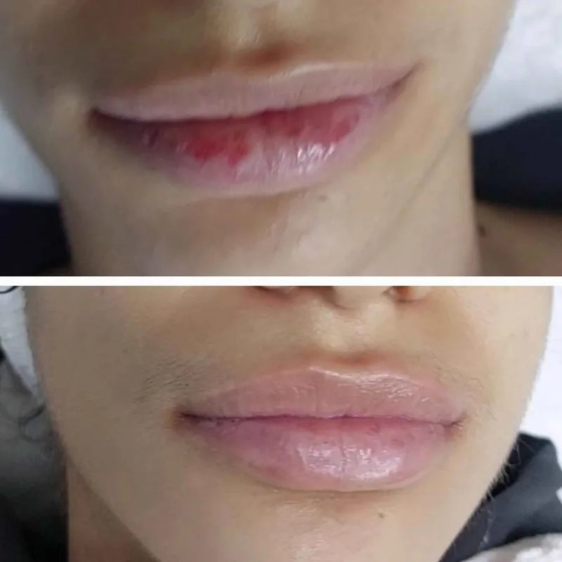 ابرسانی لبها 