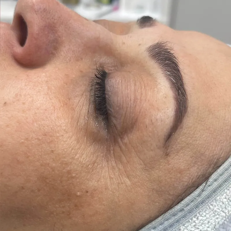 پلاژن تراپی