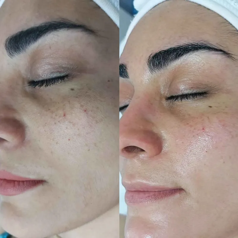 پاکسازی و فیشال پوست خشک و دهیدراته اصفهان 