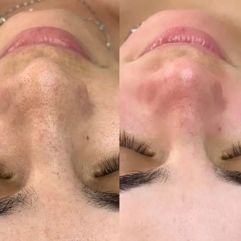 تخلیه جوش های سرسیاه وروشن سازی پوست