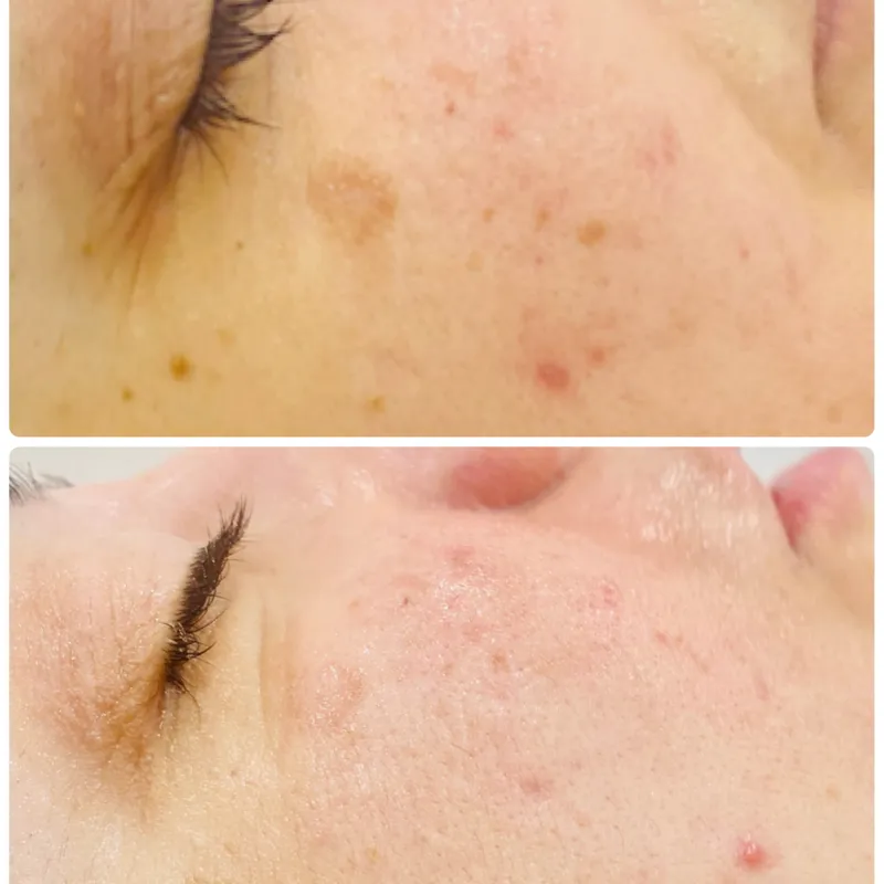 درمان لک با متد درمالانژ