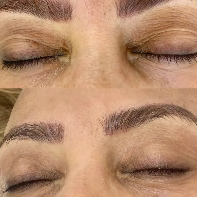 رفع تیرگی دور چشم 