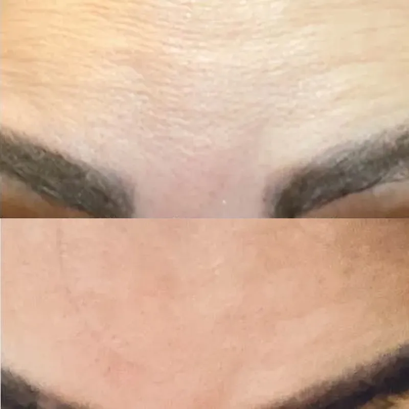 رفع خطوط و چین و چروک پیشانی 