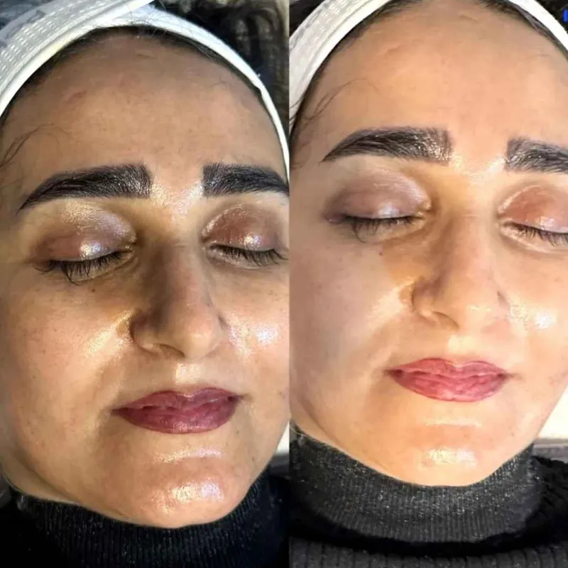 فیشال درمانی برای دوست عزیزم در جلسه سوم