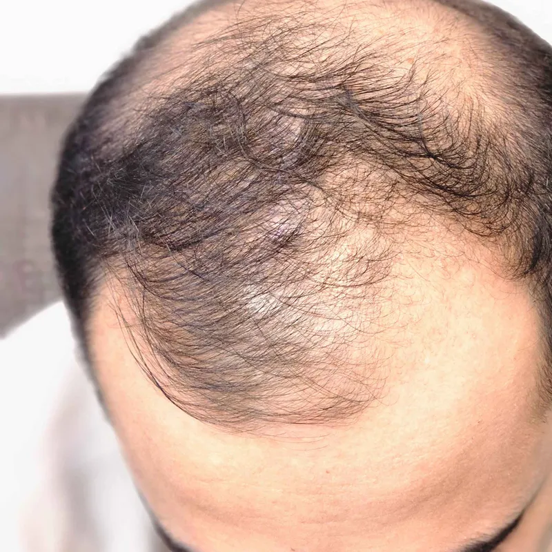 کاشت مو موقت 