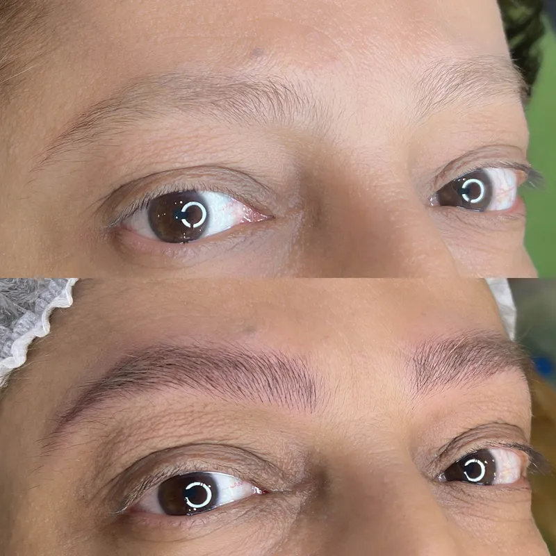 میکروبلیدینگ کرکی مویی