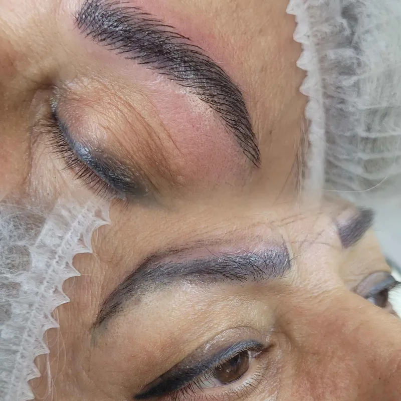 هایپرلیفت ابرو