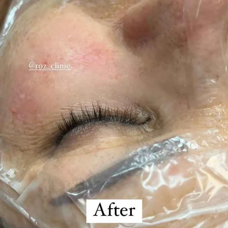 قبل و بعد مزوتراپی