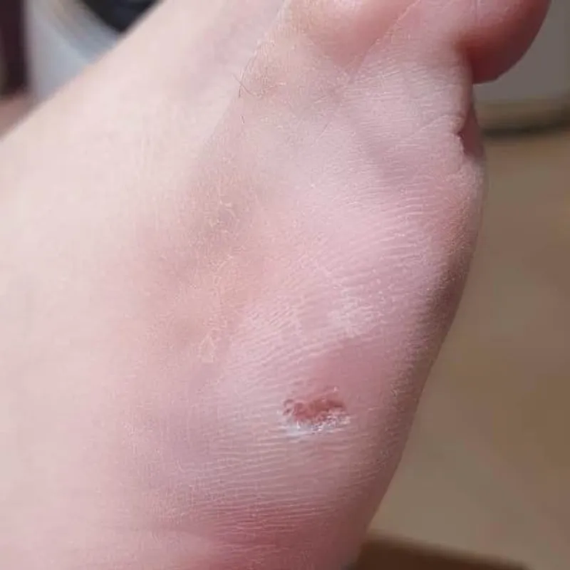 تخلیه میخچه