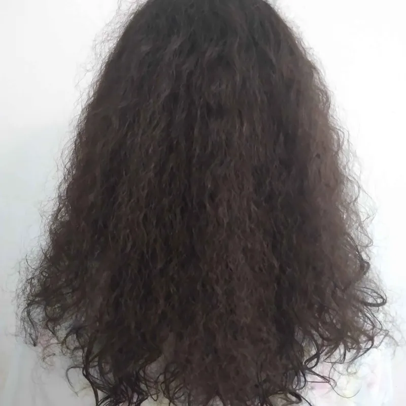 بوتاکس تراپی 