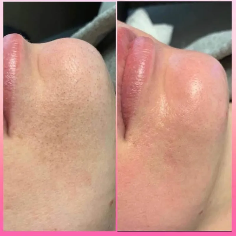 پاکسازی و فیشال پوست