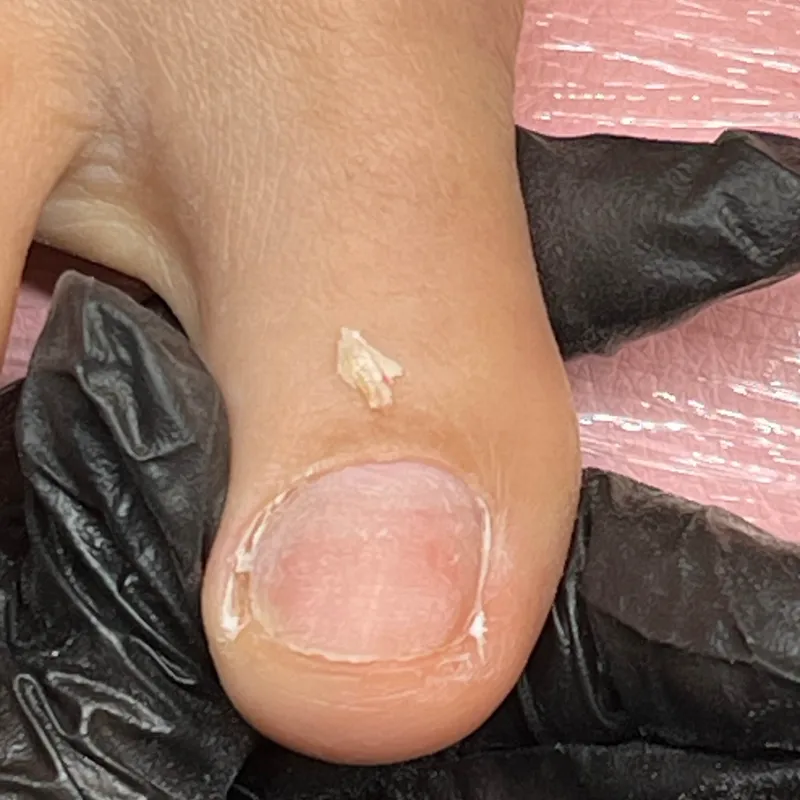 تخلیه ناخن در گوشت