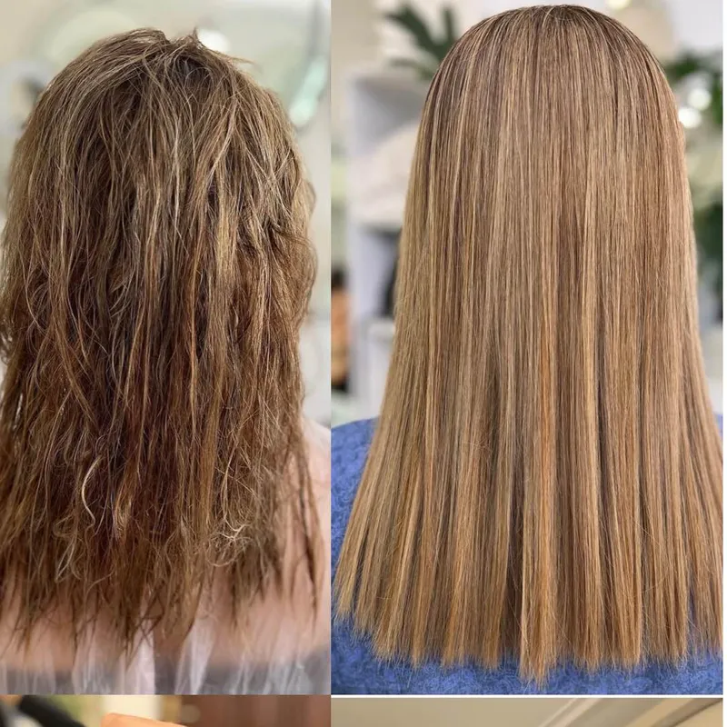 بوتاکس تراپی 