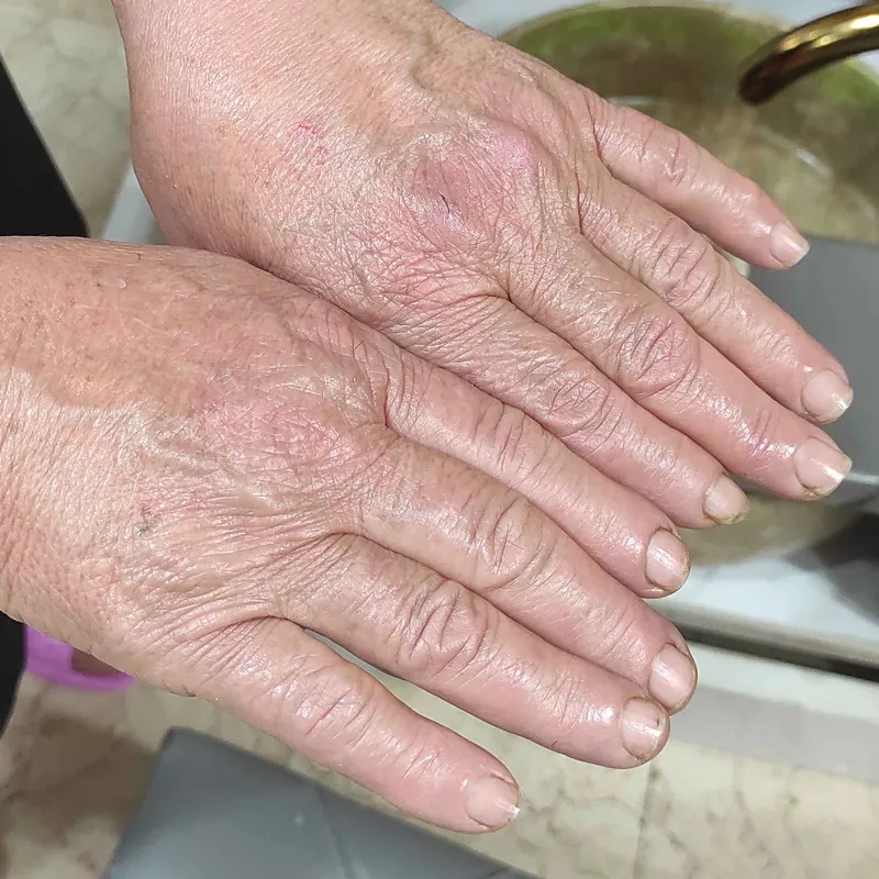 پکیج شفاف سازی دست 