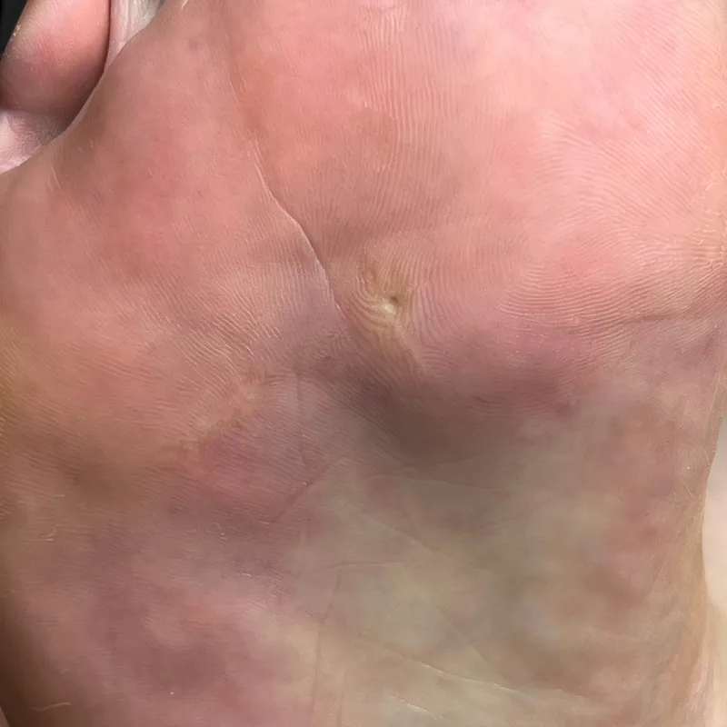 درمان مبخچه