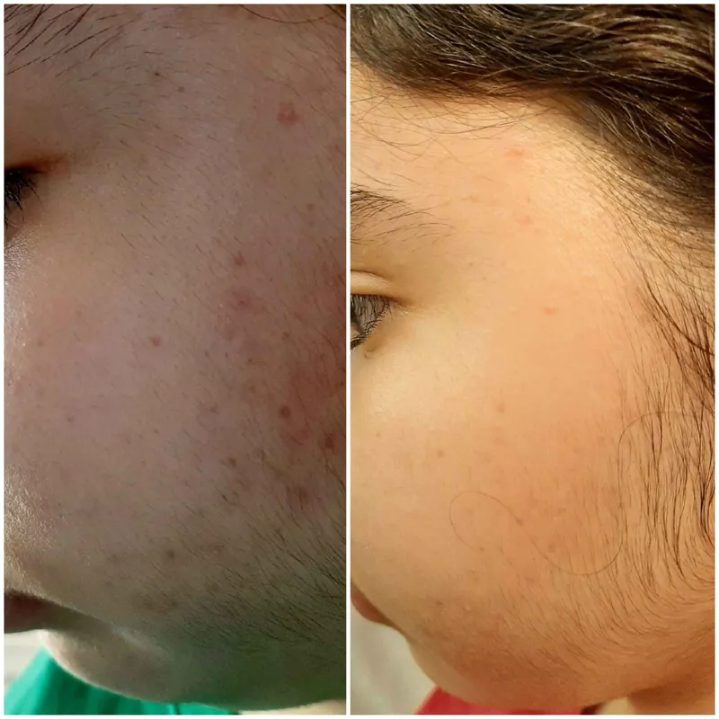 پاکسازی پوست و رفع جوشهای صورت، کنترل چربی پوست