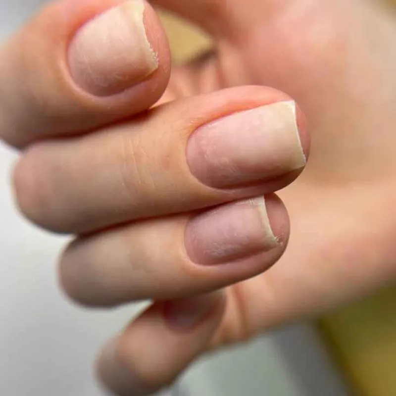 کاشت پلی ژل