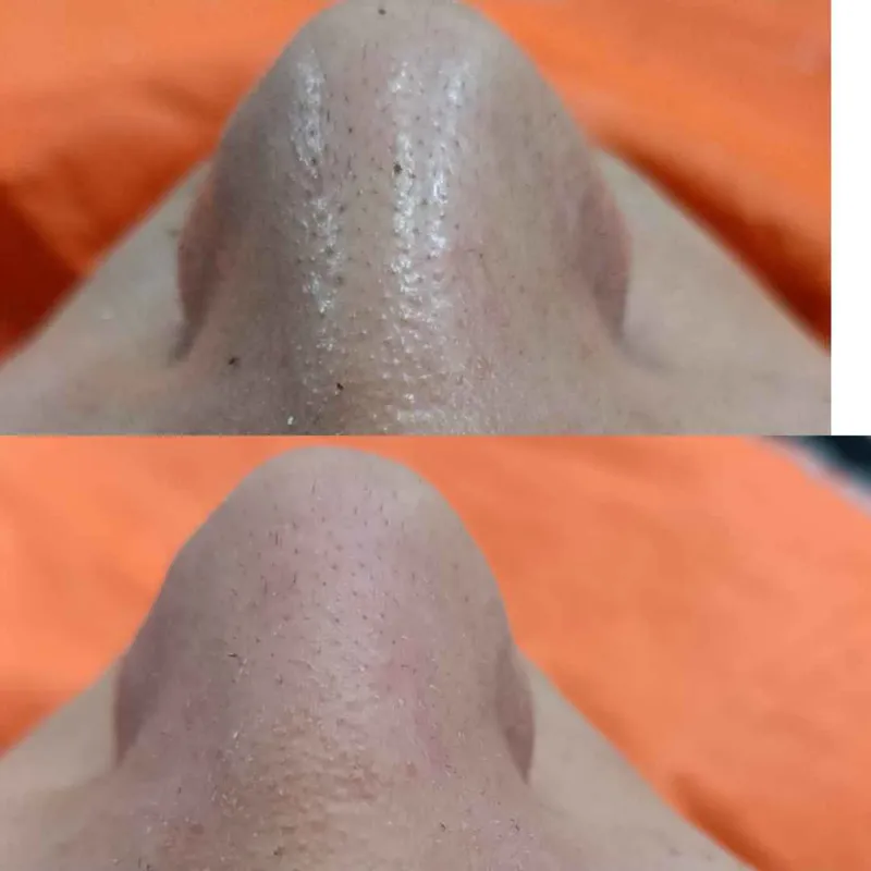 درمان جوش سرسیاه