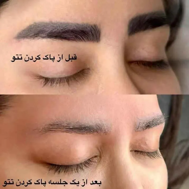 میکرو ابرو،شیدینگ لبو ریموو هرنوع تتو