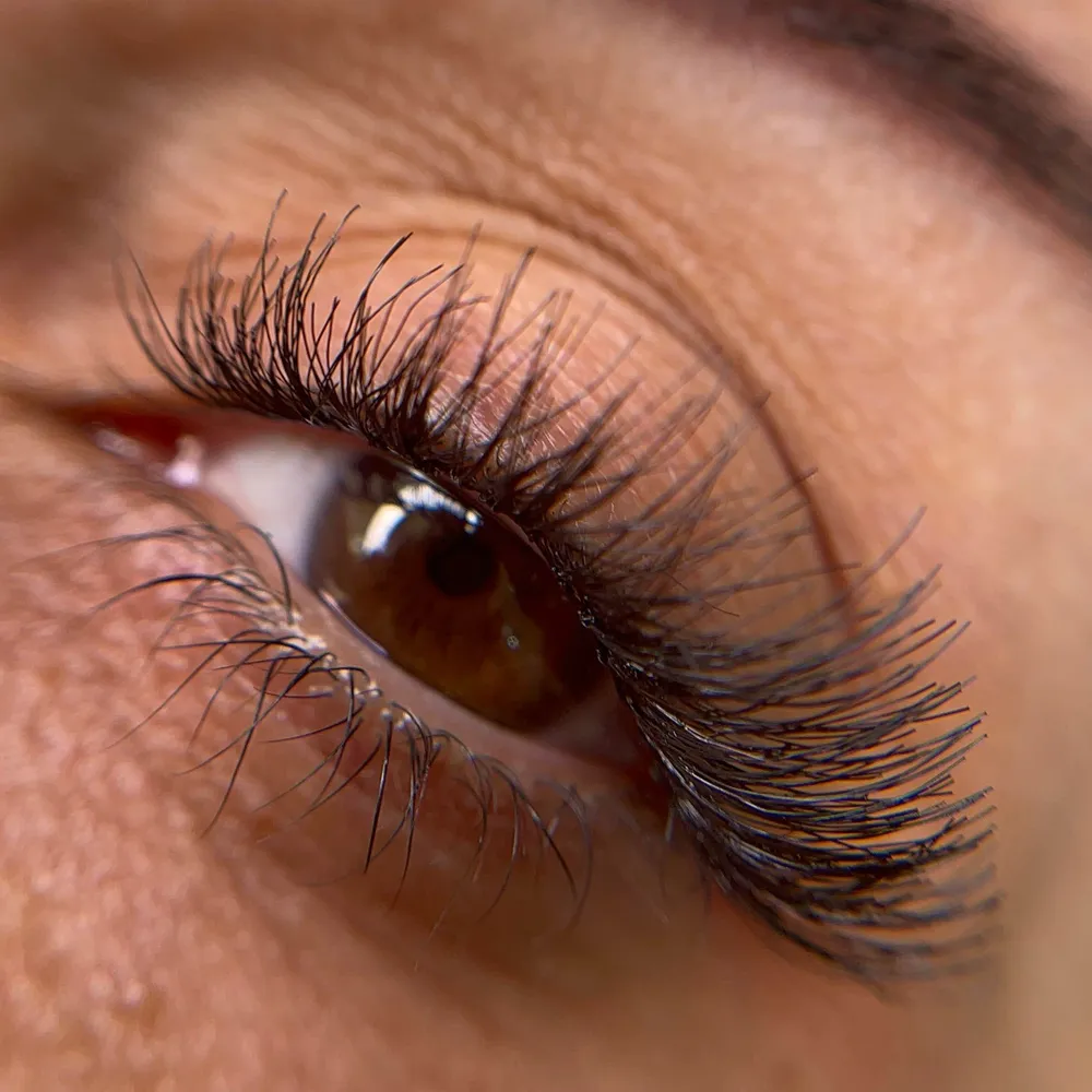 کاشت هیدن موقت