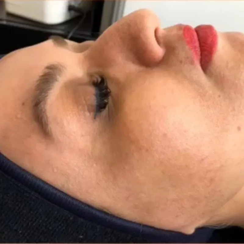 فشیال VIPبه همراه پپتاید تراپی 