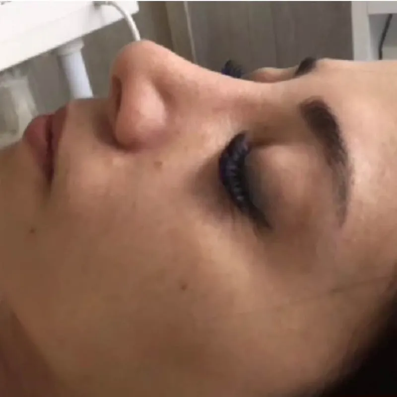 فشیال VIPبه همراه کربوکسی تراپی 