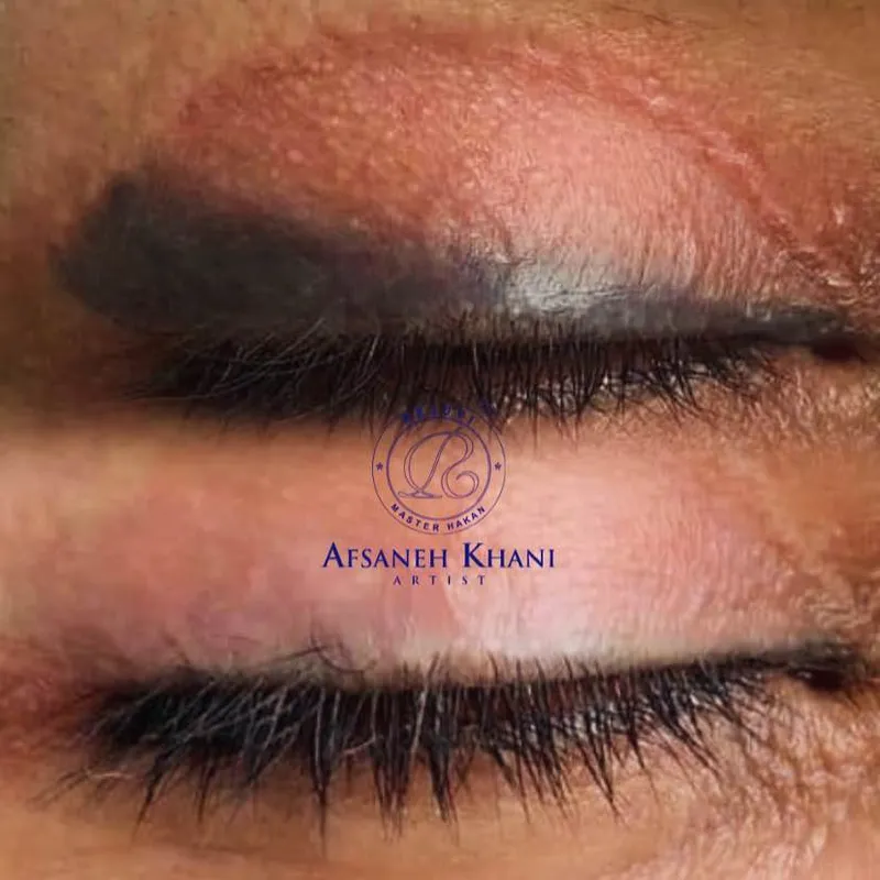 ریموو تاتوها و شیدینگ لب