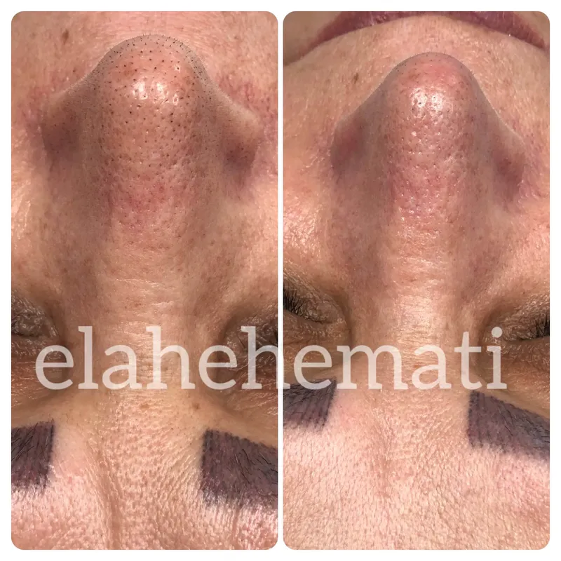 پکیج پوست چرب دهیدراته 