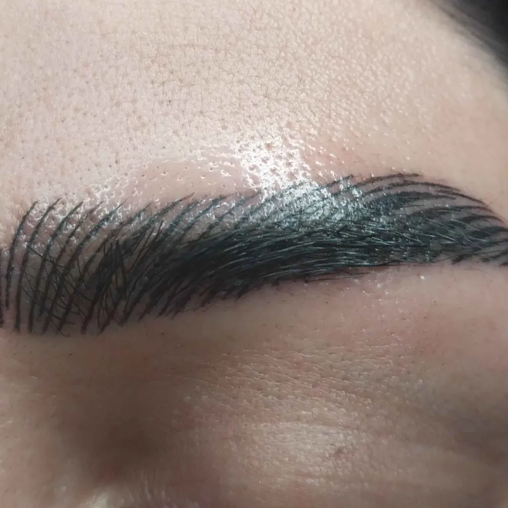 فیبروز و میکروپیگمنتیشن