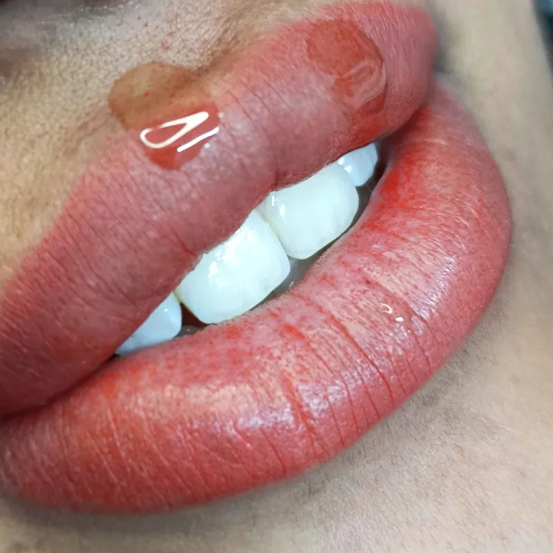 درمان تخصصی دارک لیپس 