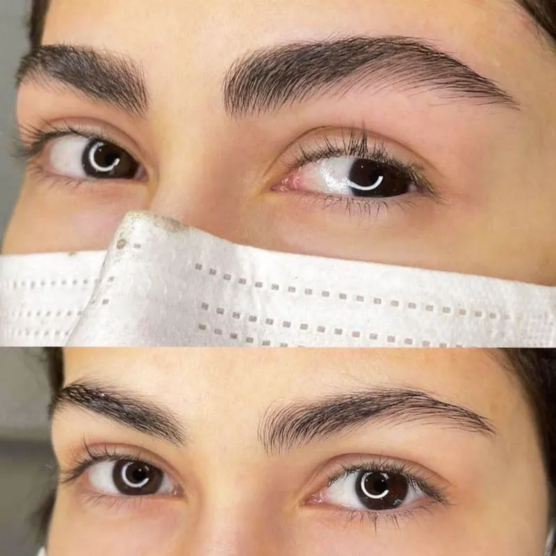 میکروبلیدینگ