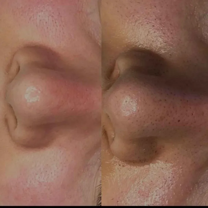 پاکسازی بینی 